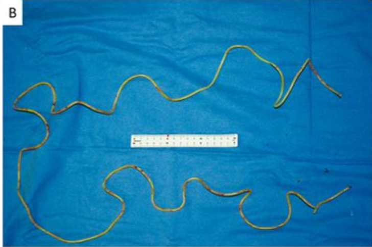 2 metrelik atlama ipini penisinin içine soktu! Doktorlar görünce şoke oldu... “Daha aşırı bir şey görmedim” G3