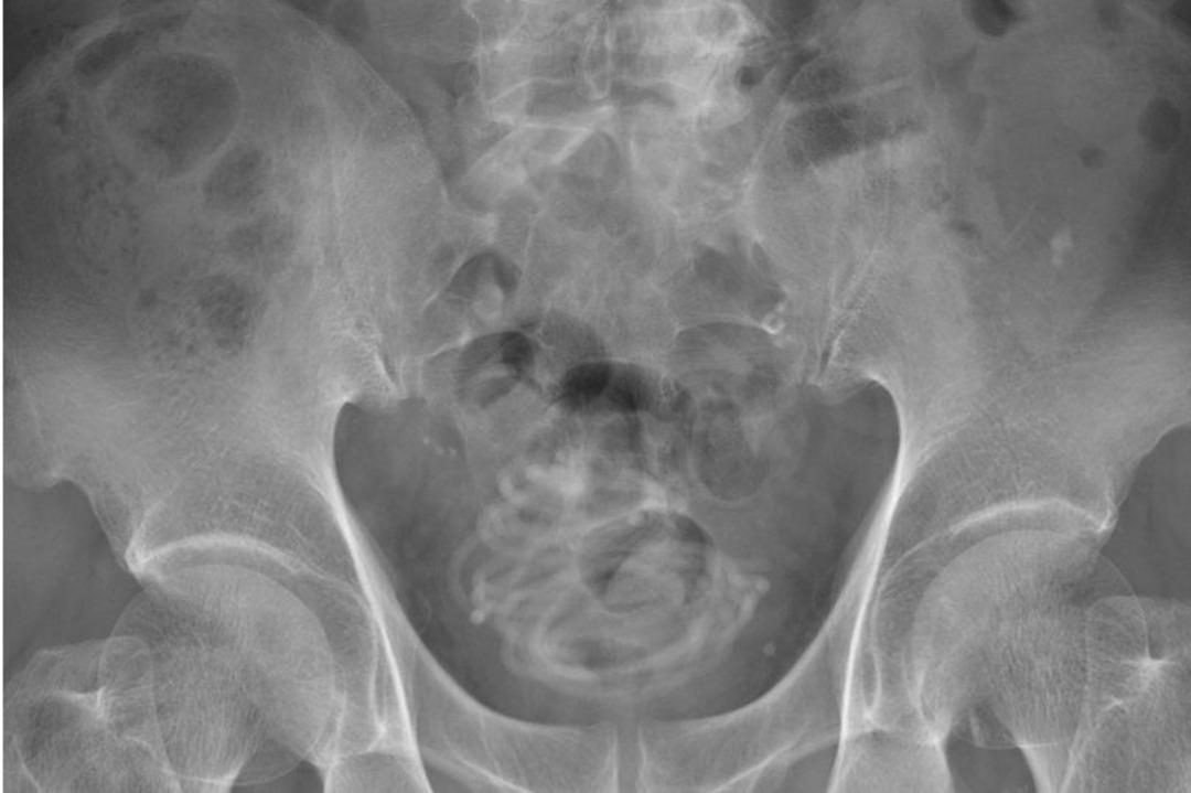 2 metrelik atlama ipini penisinin i&ccedil;ine soktu! Doktorlar g&ouml;r&uuml;nce şoke oldu... &ldquo;Daha aşırı bir şey g&ouml;rmedim&rdquo;