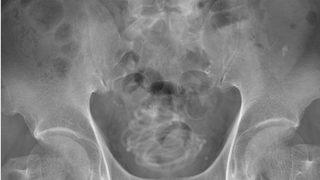 2 metrelik atlama ipini penisinin içine soktu! Doktorlar görünce şoke oldu... “Daha aşırı bir şey görmedim”