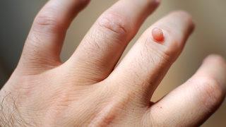 Ne yaptıysanız kurtulamadığınız can sıkıcı siğiller için reçete belli! Evdeki iki malzeme kökünü kurutuyor