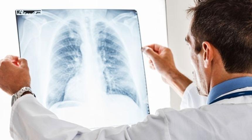 Akciğerde sıvı toplanmasına akciğer kateteri (IPC) uygulaması