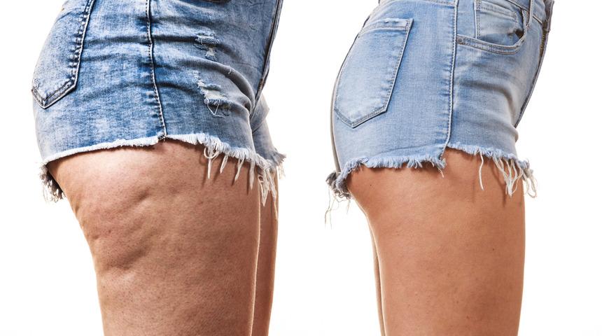 Selüliti bitiren doğal karışım! Her sabah bir bardak için