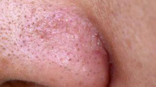 Siyah noktalardan kurtulmak işte bu kadar basit! Bir daha çıkmaması için yapmanız gerekenler...