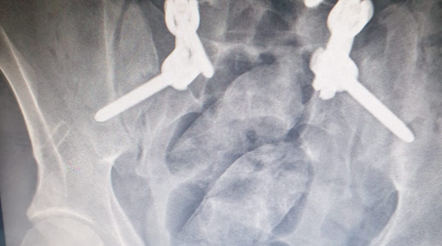 Polis peşine düştü, mide röntgeninde ortaya çıktı! Midesinde 3 paket uyuşturucu saklamış