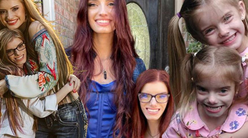 Görenler ikiz olduklarına inanamıyor! Guinness rekorunun sahibi oldular... Nadir görülen bir hastalıkla doğdu