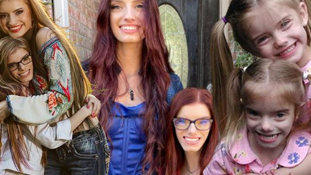 Görenler ikiz olduklarına inanamıyor! Guinness rekorunun sahibi oldular... Nadir görülen bir hastalıkla doğdu