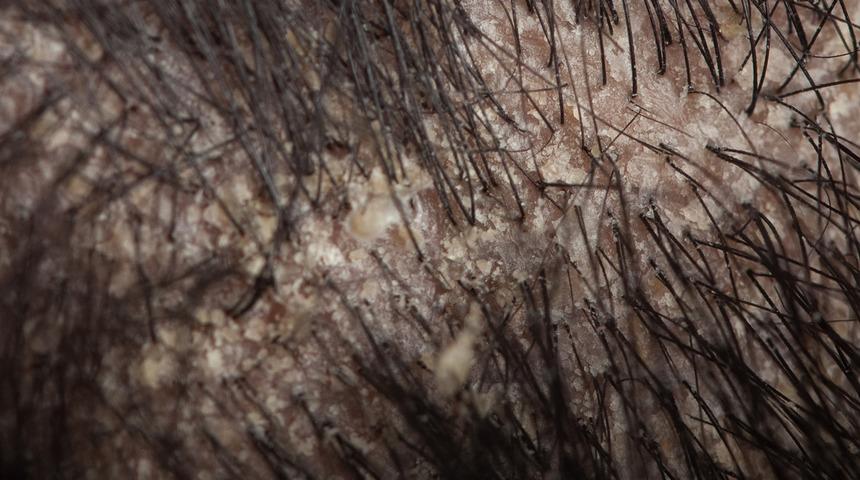 Saç yağlanmasına çözüm bulmak için çuvalla para harcamayın! Çözümü evinizde