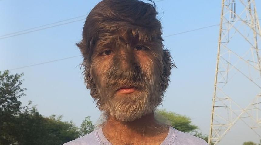 Yaşayan kurt adam anlattı! Orta Çağ'dan beri sadece 50 kişide görüldü