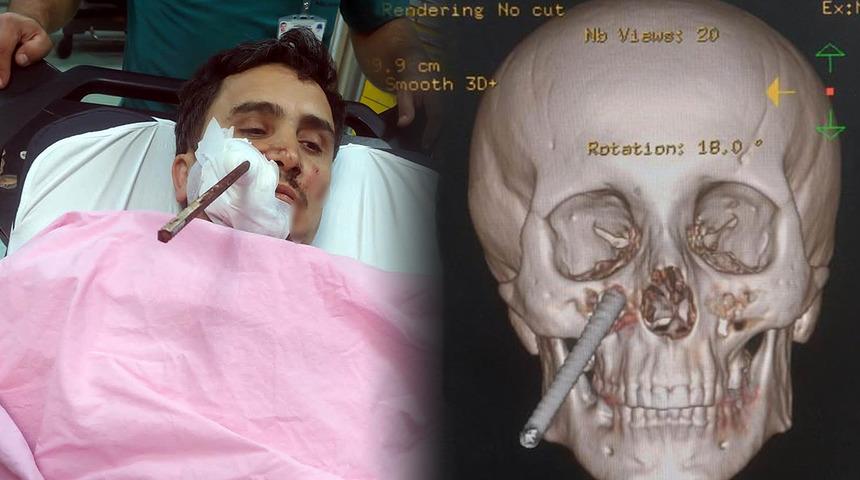 Korkunç olay! İnşaat demiri yüzüne saplandı