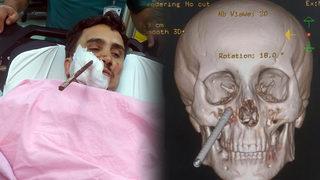 Korkunç olay! İnşaat demiri yüzüne saplandı