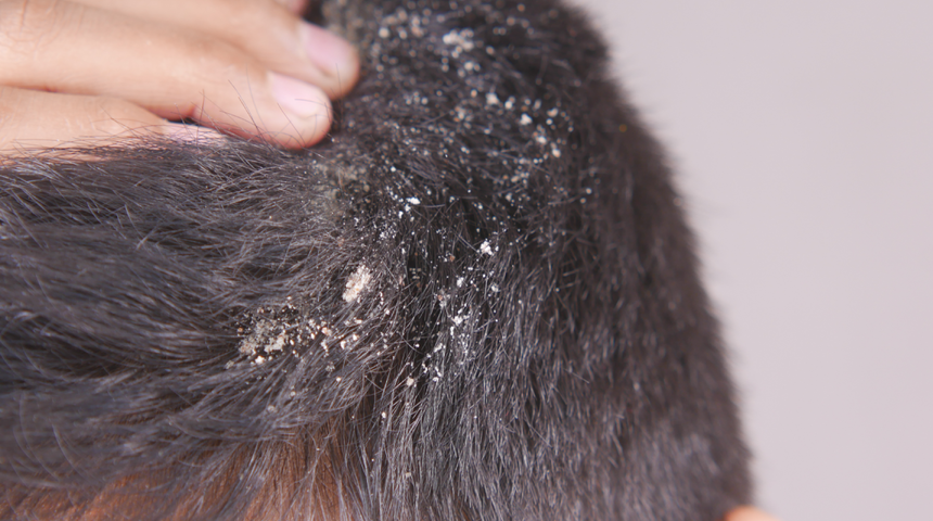 Basit saç kepeği diyerek geçiştirmeyin! Kafa derisinde görülen bu durum tehlikeli hastalığın ciddi belirtisi