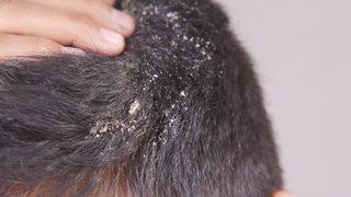 Basit saç kepeği diyerek geçiştirmeyin! Kafa derisinde görülen bu durum tehlikeli hastalığın ciddi belirtisi