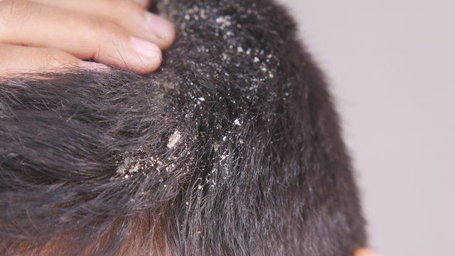 Basit saç kepeği diyerek geçiştirmeyin! Kafa derisinde görülen bu durum tehlikeli hastalığın ciddi belirtisi