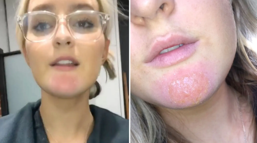 Erkek arkadaşının sakalı nedeniyle enfeksiyon kapan kadın TikTok &uuml;zerinden uyardı!