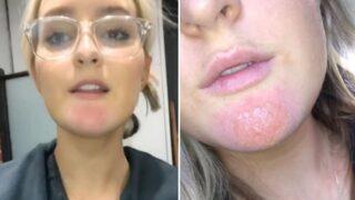 Erkek arkadaşının sakalı nedeniyle enfeksiyon kapan kadın TikTok üzerinden uyardı!