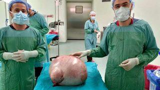 Karın şişliği için gitti, vücudundan 35 kiloluk kitle çıkarıldı! 'Dünyanın en büyüğü olabilir'