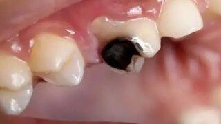 Verdiği acı dayanılmaz! Çürükleri önlemenin yolu çok basit 