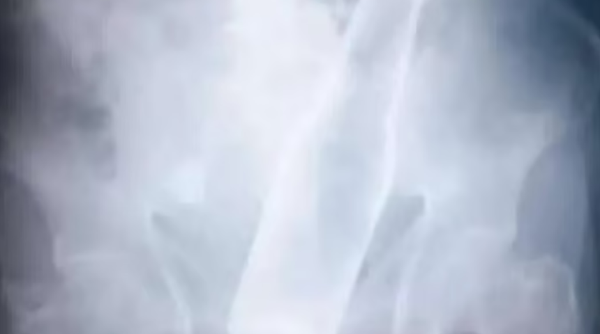 Venezuelalı adamdan çıkartılan şişe doktorları bile şaşırttı! İstediği eşyayı çalamayan hırsızlar sinirlenince...