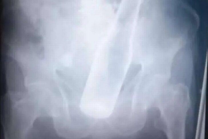 Dehşeti yaşadı! Hırsızlar çalacak bir şey bulayınca makatına şişe sıkıştırdı... Doktorlar görünce şaşırdı