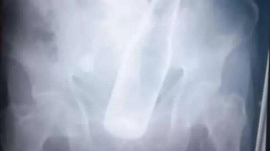 Dehşeti yaşadı! Hırsızlar çalacak bir şey bulayınca makatına şişe sıkıştırdı... Doktorlar görünce şaşırdı