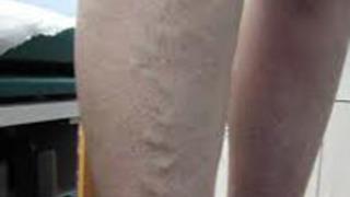 Lazerle Varis Tedavisi