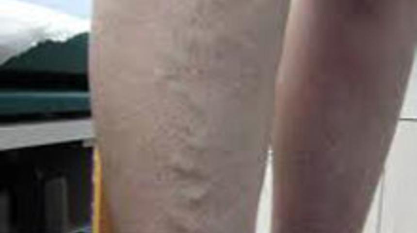 Lazerle Varis Tedavisi