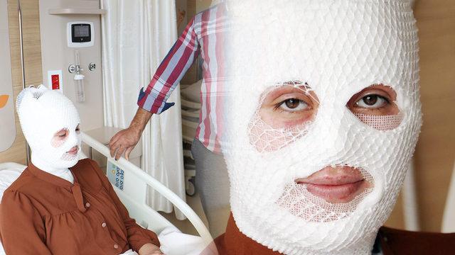 Yemek yaparken kabusu yaşadı! Bomba gibi patladı: Yüzümdeki derinin dökülmeye başladığını gördüm