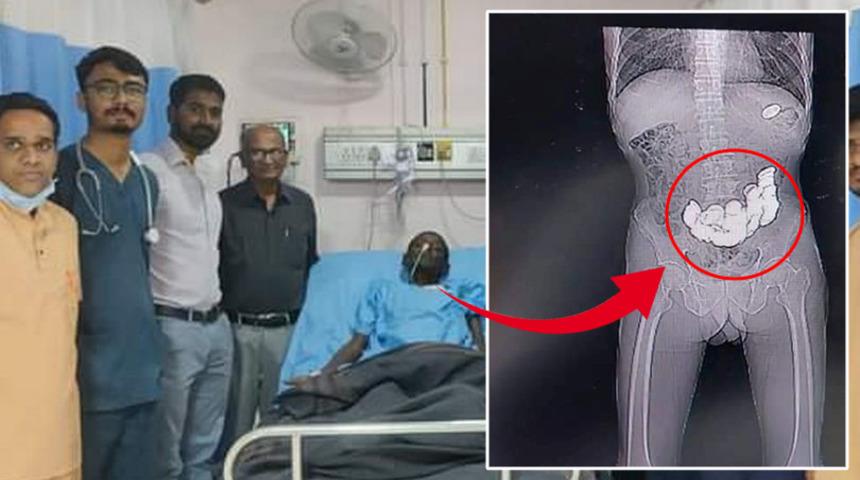 Hastaneye şişkinlik şikayetiyle gitmişti! Midesinden çıkanlar şoke etti: Tam 187 tane...