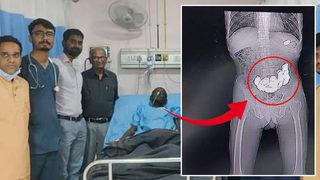 Hastaneye şişkinlik şikayetiyle gitmişti! Midesinden çıkanlar şoke etti: Tam 187 tane...