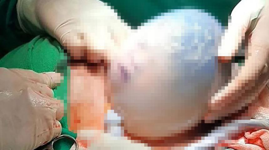 Dünya bu bebeği konuşuyor! Bozulmamış amniyon kesesinin içindeyken doğan bebek herkesi şaşkına çevirdi