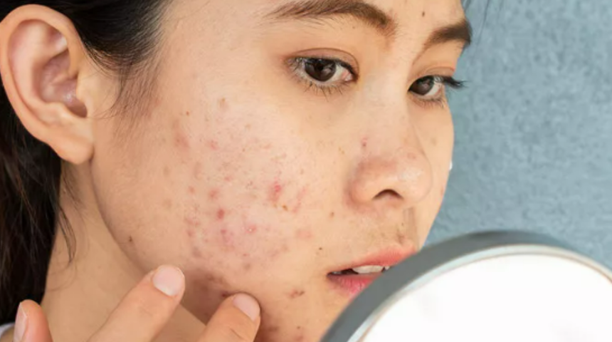 TikTok trendleri şaşırtmaya devam ediyor! Sivilceleri geçirmek için yüze şampuan kullanmak faydalı mı?