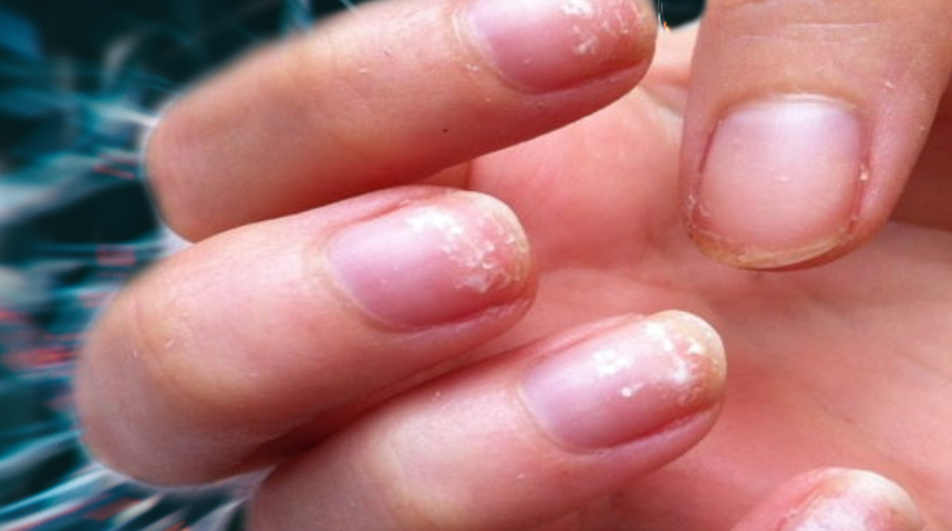 Tırnaklardaki değişikliklere dikkat! Hastalığın en erken belirtisi... Sakın önemsiz sanmayın