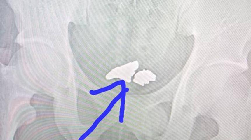 Böyle hırsızlık görülmedi! 81 gram altını yutarak çalmak istedi... Metal dedektörüne yakalandı