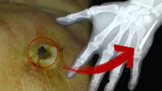 Elinin acısıyla hastaneye gitti, hayatının şokunu yaşadı! Röntgende ortaya çıktı, 2 aydır...