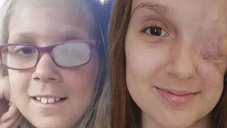 Her şey göz tembelliğiyle başladı! Göz çukuru alındıktan sonra hayatını kaybetti