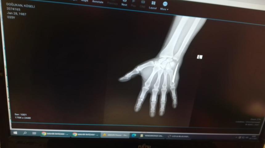 Röntgen çekilmeden dikiş atıldı! 2 ay boyunca bu halde yaşadı... Ağrılara dayanamayınca ortaya çıktı