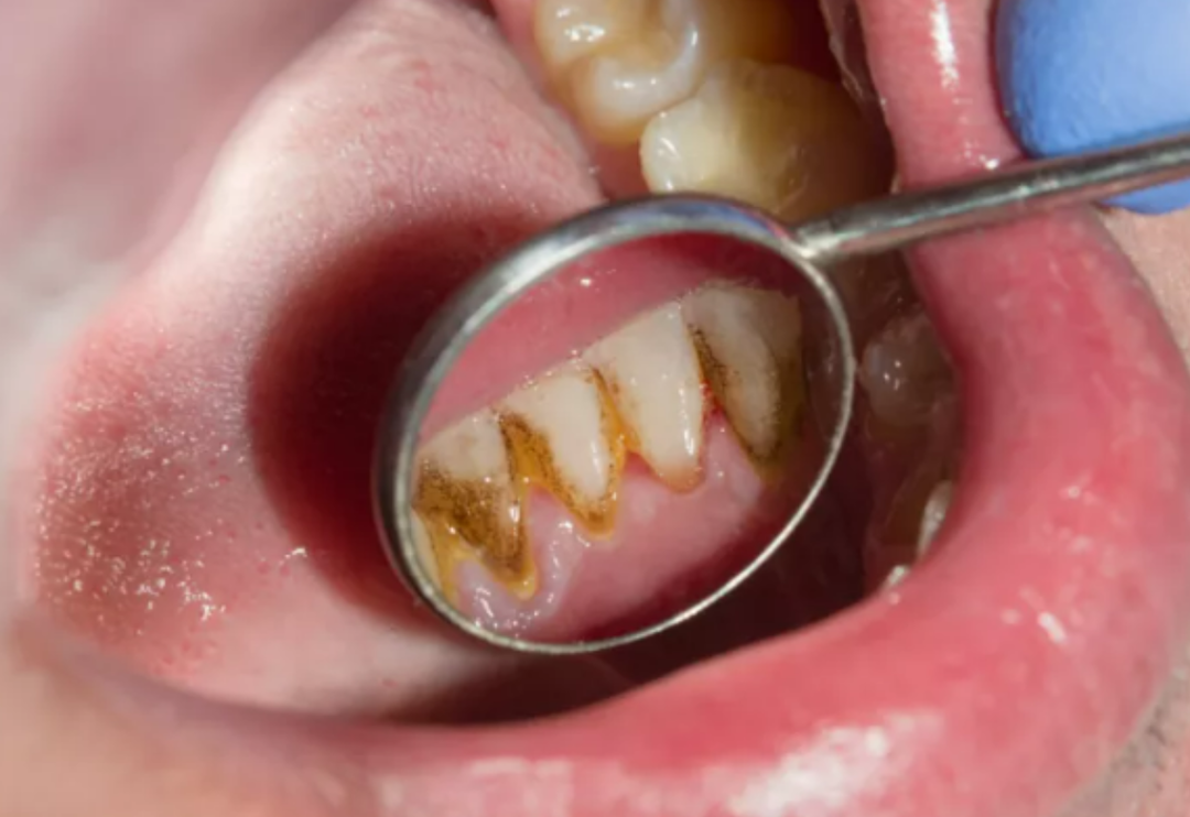 Her evde bulunuyor! Diş tartarlarını ve taşlarını yok edecek &ccedil;&ouml;z&uuml;mler