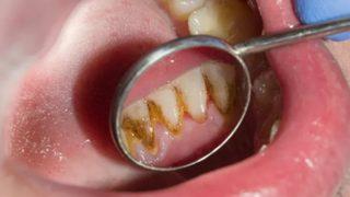 Her evde bulunuyor! Diş tartarlarını ve taşlarını yok edecek çözümler