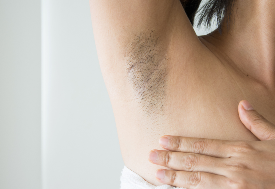 Acı &ccedil;ekmenize gerek yok! İstenmeyen t&uuml;ylerinizi doğal olarak yok edecek &ccedil;&ouml;z&uuml;mler