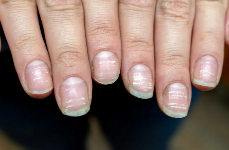 TIRNAK LEKELERİNİ GİDERİR 