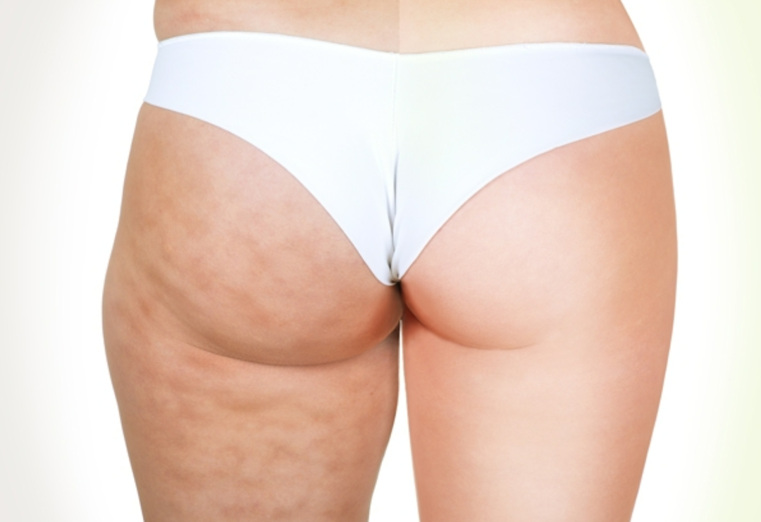 Sel&uuml;litlere veda edin! P&uuml;r&uuml;zs&uuml;z bacaklara kavuşmanın yolu &ccedil;ok basit