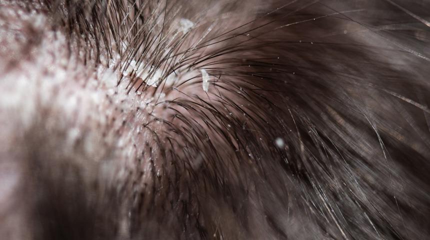 Çuvalla para vermeyin! Kepek sorununu kökten çözen iksir