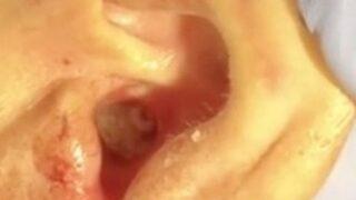 Ağrıdan duramayıp hastaneye koştu! Kulağının içinden yüzlerce kurtçuk çıkınca doktorlar bile şaşkına döndü