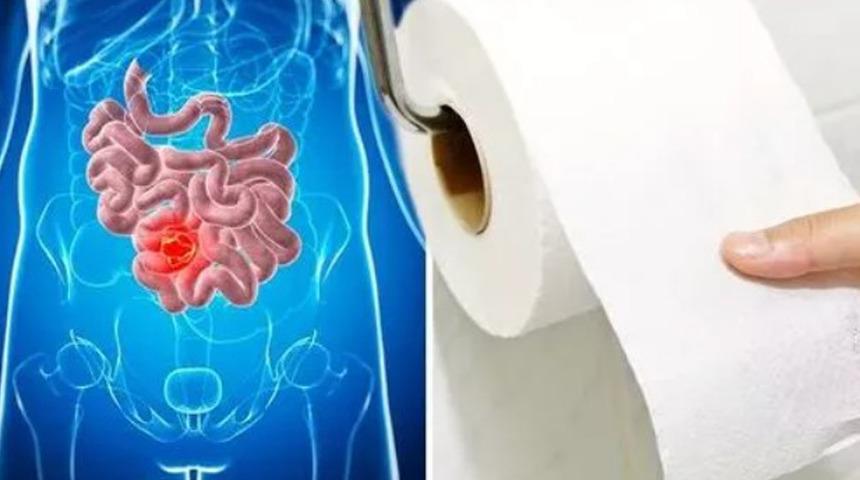 Bağırsak kanserinin en erken belirtisi: %89'unda görülüyor