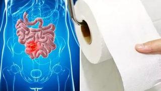 Bağırsak kanserinin en erken belirtisi: %89'unda görülüyor