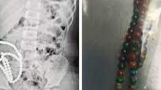 Karnından çıkartılan boncuklar saymakla bitmedi! Bağırsakları parçalanmış...