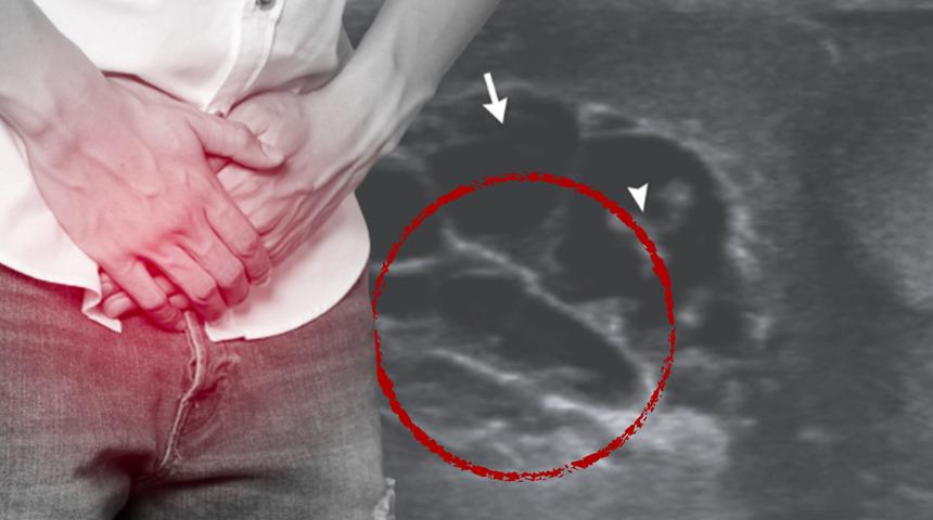 Patlayacak gibiydi! Hastaneye zor yetişen adam doktorları şoke etti... Testis torbasından ‘dans eden solucanlar’ çıktı