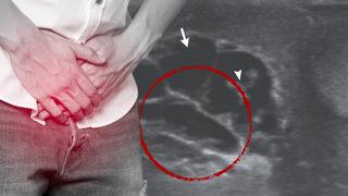 Patlayacak gibiydi! Hastaneye zor yetişen adam doktorları şoke etti... Testis torbasından ‘dans eden solucanlar’ çıktı