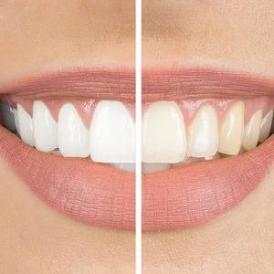 Diş sağlığı aksatmaya gelmez! Sağlığınızı baştan aşağı etkiliyor