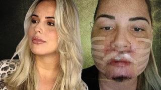 Estetik operasyonlar kabusu oldu! Yüzünün şekli tamamen bozuldu... “Yüzümü geri istiyorum”